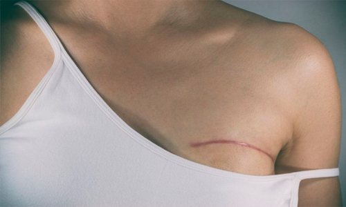 Проснулась без груди: в Харькове врачи без предупреждения ампутировали женщине молочную железу